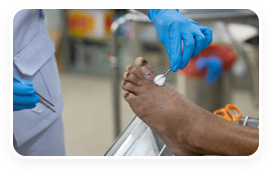 Atlanta mobile wound care specialist treating an arterial ulcer of a patient.