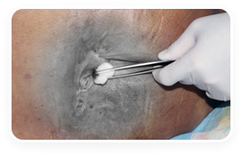 Atlanta mobile wound care specalist care for a sacral ulcer.