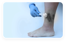 Atlanta mobile wound care specialist caring for a veneous leg ulcer.