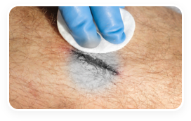 Atlanta mobile wound care specialist caring for a patient suffering from wound dehiscence.