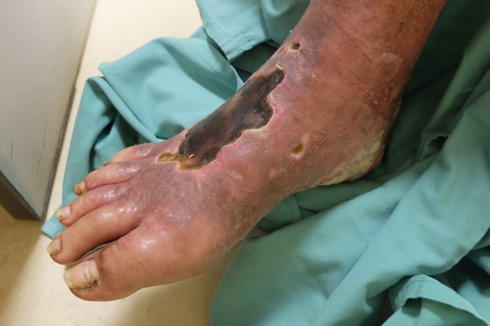 At-home wound care for arterial ulcers.
