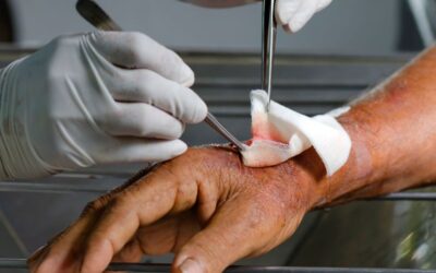 What Are the 5 Rules of Wound Care?